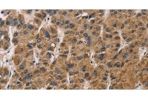 Immunohistochemistry of paraffin-embedded Human liver cancer tissue using IL19 Polyclonal Antibody at dilution 1:40 (IL-19 antibody)