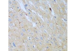 Immunohistochemistry of paraffin-embedded Human liver cancer using CEACAM7 Polyclonal Antibody at dilution of 1:100 (40x lens). (CEACAM7 antibody)