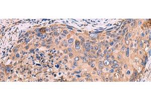 Immunohistochemistry of paraffin-embedded Human cervical cancer tissue using GUSB Polyclonal Antibody at dilution of 1:50(x200) (Glucuronidase beta antibody)