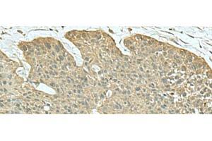 Immunohistochemistry of paraffin-embedded Human esophagus cancer tissue using FN3KRP Polyclonal Antibody at dilution of 1:55(x200) (FN3KRP antibody)