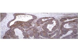 Immunohistochemical staining of human colon carcinoma tissue using TIMP-2 antibody . (TIMP2 antibody)