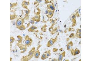 Immunohistochemistry of paraffin-embedded Human liver cancer using BTD Polyclonal Antibody at dilution of 1:100 (40x lens). (BTD antibody)