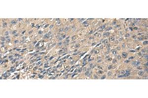 Immunohistochemistry of paraffin-embedded Human liver cancer tissue using ZG16 Polyclonal Antibody at dilution of 1:95(x200) (ZG16 antibody)