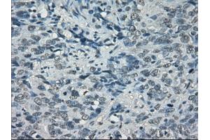 Immunohistochemical staining of paraffin-embedded Carcinoma of bladder tissue using anti-PORmouse monoclonal antibody. (POR antibody)