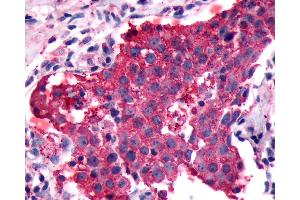 Anti-PGR1 / GPR153 antibody IHC of human Breast, Carcinoma.