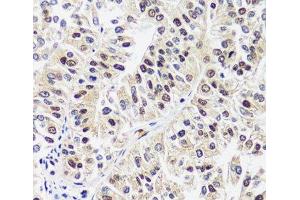 Immunohistochemistry of paraffin-embedded Human uterine cancer using CAND1 Polyclonal Antibody at dilution of 1:100 (40x lens). (CAND1 antibody)