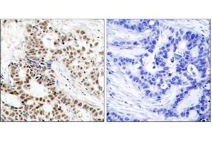 Immunohistochemical analysis of paraffin-embedded human breast carcinoma tissue, using BRCA1 (phospho-Ser1423) antibody (E011242). (BRCA1 antibody  (pSer1423))
