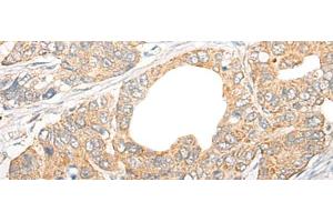 Immunohistochemistry of paraffin-embedded Human gastric cancer tissue using CCL5 Polyclonal Antibody at dilution of 1:50(x200) (CCL5 antibody)