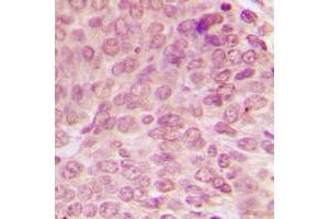 Immunohistochemical analysis of p53 (pS15) staining in human breast cancer formalin fixed paraffin embedded tissue section.