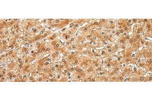 Immunohistochemistry of paraffin-embedded Human liver cancer tissue using DRD3 Polyclonal Antibody at dilution of 1:25(x200) (DRD3 antibody)