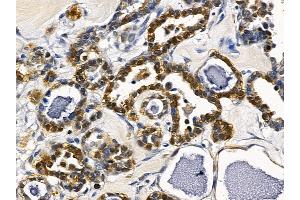 ABIN6257125 and ABIN6274536 at 1/100 staining human ovarian cancer by IHC-P.