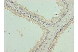 Immunohistochemistry of paraffin-embedded human prostate cancer using ABIN7157364 at dilution of 1:100