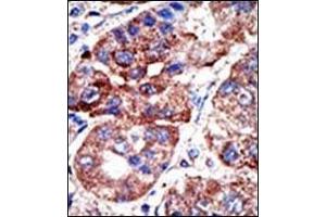 Formalin-fixed and paraffin-embedded human cancer tissue reacted with the SQSTM1 Antibody , which was peroxidase-conjugated to the secondary antibody, followed by DAB staining. (SQSTM1 antibody  (C-Term))