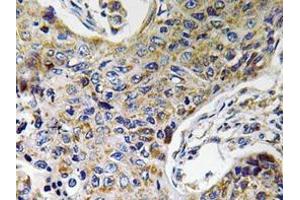 Immunohistochemistry analyzes of ATP5J2 antibody in paraffin-embedded human lung carcinoma tissue. (ATP5J2 antibody  (Subunit F))