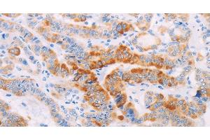 Immunohistochemistry of paraffin-embedded Human thyroid cancer using MAP4K3 Polyclonal Antibody at dilution of 1:30 (MAP4K3 antibody)