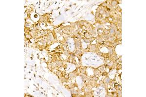 Immunohistochemistry of paraffin-embedded human breast cancer using B1 Rabbit pAb (ABIN6129916, ABIN6136962, ABIN6136963 and ABIN6222795) at dilution of 1:150 (40x lens).