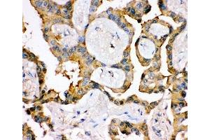 IHC-P: IRS1 antibody testing of human lung cancer tissue (IRS1 antibody  (AA 1041-1242))