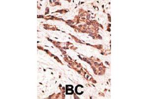 Formalin-fixed and paraffin-embedded human cancer tissue reacted with LPAR2 polyclonal antibody  , which was peroxidase-conjugated to the secondary antibody, followed by AEC staining. (EDG4 antibody  (N-Term))