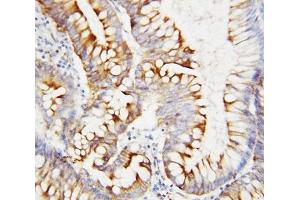 IHC-P: SPARC antibody testing of human intestinal cancer tissue (SPARC antibody  (AA 284-303))