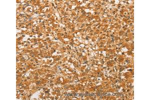 Immunohistochemistry of Human colon cancer using BCL2L14 Polyclonal Antibody at dilution of 1:40 (BCL2L14 antibody)