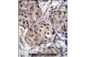 CBLN2 Antibody (C-term) (ABIN655780 and ABIN2845215) immunohistochemistry analysis in formalin fixed and paraffin embedded human breast carcinoma followed by peroxidase conjugation of the secondary antibody and DAB staining. (CBLN2 antibody  (C-Term))