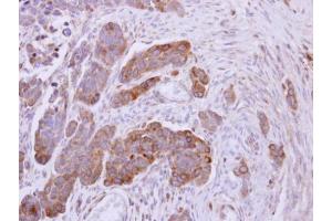 IHC-P Image NDUFS1 antibody detects NDUFS1 protein at mitochondria on human ovarian carcinoma by immunohistochemical analysis. (NDUFS1 antibody  (Center))
