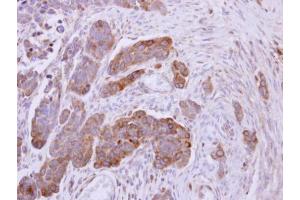 IHC-P Image NDUFS1 antibody detects NDUFS1 protein at mitochondria on human ovarian carcinoma by immunohistochemical analysis.