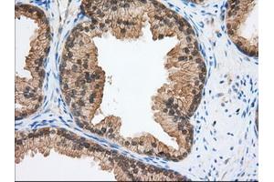 Immunohistochemical staining of paraffin-embedded Adenocarcinoma of Human ovary tissue using anti-TACC3 mouse monoclonal antibody. (TACC3 antibody)