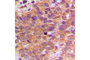 Immunohistochemical analysis of ABL1 staining in human breast cancer formalin fixed paraffin embedded tissue section. (ABL1 antibody  (C-Term))
