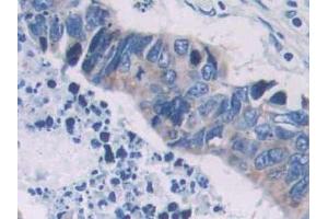 IHC-P analysis of Human Colorectal cancer Tissue, with DAB staining. (PCOLCE antibody  (AA 315-437))