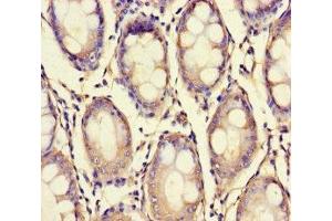 Immunohistochemistry of paraffin-embedded human colon cancer using ABIN7175909 at dilution of 1:100 (XPNPEP1 antibody  (AA 2-623))