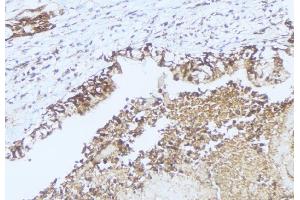 ABIN6275463 at 1/100 staining Human lung cancer tissue by IHC-P. (RAB2A antibody  (Internal Region))