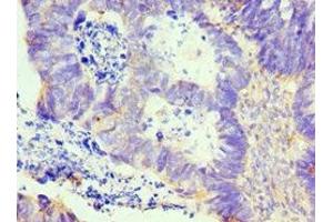 Immunohistochemistry of paraffin-embedded human ovarian cancer using ABIN7157975 at dilution of 1:100 (Leiomodin 1 antibody  (AA 29-187))