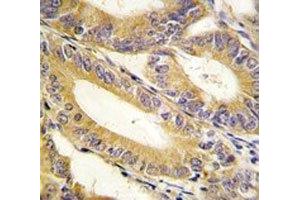 IHC analysis of FFPE human colon carcinoma tissue stained with XIAP antibody (XIAP antibody  (AA 1-30))