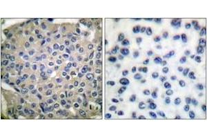 Immunohistochemistry analysis of paraffin-embedded human breast carcinoma, using Cortactin (Phospho-Tyr466) Antibody.