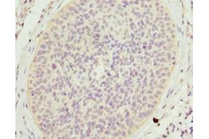 Immunohistochemistry of paraffin-embedded human cervical cancer using ABIN7158965 at dilution of 1:100 (Mammaglobin A antibody  (AA 1-93))