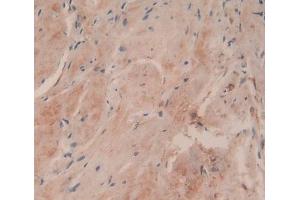 IHC-P analysis of Human Breast Cancer Tissue, with DAB staining. (COL6a3 antibody  (AA 463-624))