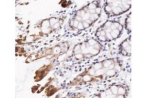 ABIN6267473 at 1/200 staining human colon cancer tissue sections by IHC-P. (AKT1 antibody  (pThr308))