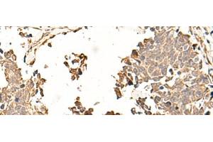 Immunohistochemistry of paraffin-embedded Human lung cancer tissue using SOX3 Polyclonal Antibody at dilution of 1:50(x200)