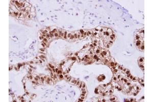 IHC-P Image DNAJB2 antibody detects DNAJB2 protein at cytosol on human ovarian Carcinoma by immunohistochemical analysis. (DNAJB2 antibody  (Center))