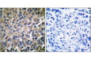 Immunohistochemistry analysis of paraffin-embedded human breast carcinoma tissue, using GRP78 Antibody. (GRP78 antibody  (AA 605-654))