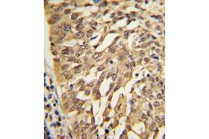 Formalin-fixed and paraffin-embedded human lung carcinoma with SAR1A Antibody (Center), which was peroxidase-conjugated to the secondary antibody, followed by DAB staining. (SAR1A antibody  (AA 122-149))