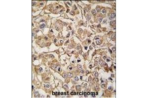 Formalin-fixed and paraffin-embedded human breast carcinoma tissue reacted with MYLK3 antibody (N-term) (ABIN392494 and ABIN2837985) , which was peroxidase-conjugated to the secondary antibody, followed by DAB staining. (MYLK3 antibody  (N-Term))