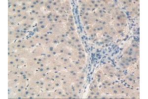 IHC-P analysis of Human Liver Cancer Tissue, with DAB staining. (Retinol Binding Protein 5 antibody  (AA 2-135))