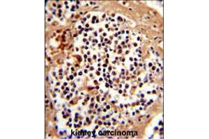 Formalin-fixed and paraffin-embedded human kidney carcinoma reacted with SERPINB7 Antibody , which was peroxidase-conjugated to the secondary antibody, followed by DAB staining.