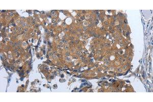 Immunohistochemistry of paraffin-embedded Human breast cancer tissue using PDIA2 Polyclonal Antibody at dilution 1:50 (PDIA2 antibody)