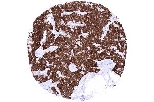 Thyroid Medullary carcinoma with strong cytoplasmic synaptophysin immunostaining of all tumor cells (Recombinant Synaptophysin antibody  (AA 274-313))