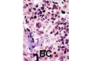 Formalin-fixed and paraffin-embedded human cancer tissue reacted with PRKAR1B polyclonal antibody  , which was peroxidase-conjugated to the secondary antibody, followed by AEC staining. (PRKAR1B antibody  (N-Term))