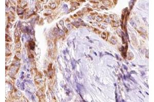 ABIN6267637 at 1/100 staining human Thyroid cancer tissue sections by IHC-P.