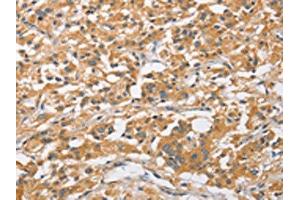 The image on the left is immunohistochemistry of paraffin-embedded Human thyroid cancer tissue using ABIN7128517(ARL8A Antibody) at dilution 1/20, on the right is treated with fusion protein. (ARL8A antibody)
